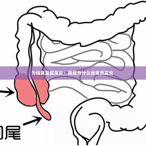 为啥突发阑尾炎:阑尾为什么会突然发炎