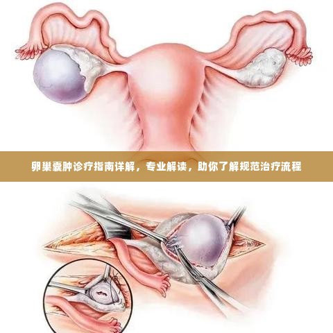 卵巢囊肿诊疗指南详解，专业解读，助你了解规范治疗流程