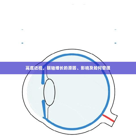 高度近视，眼轴增长的原因、影响及如何管理