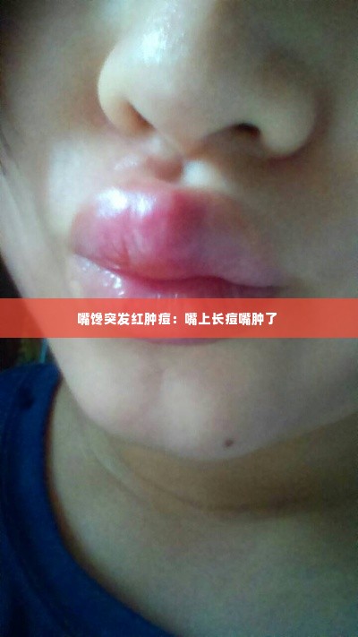 嘴馋突发红肿痘:嘴上长痘嘴肿了