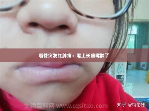 嘴馋突发红肿痘:嘴上长痘嘴肿了