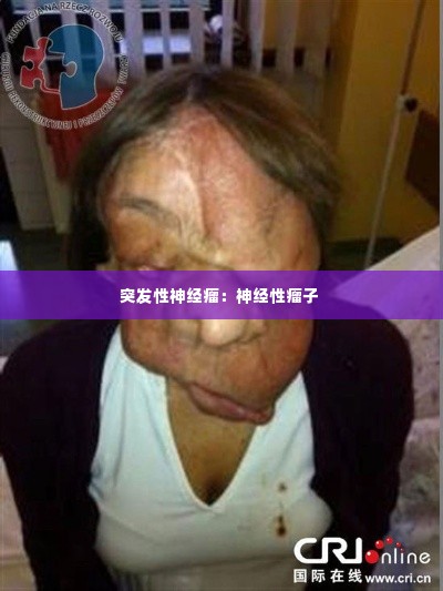 突发性神经瘤：神经性瘤子 