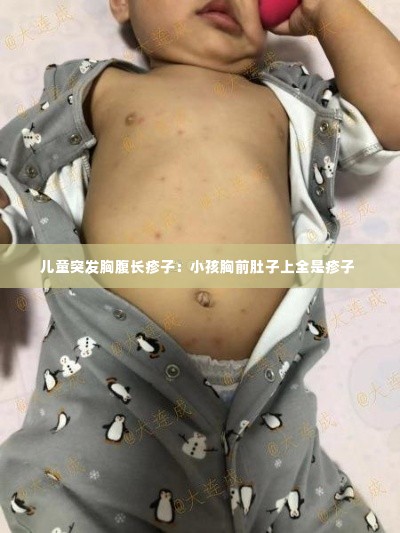 儿童突发胸腹长疹子:小孩胸前肚子上全是疹子