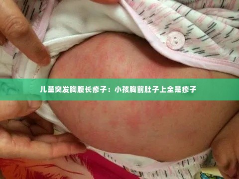 儿童突发胸腹长疹子:小孩胸前肚子上全是疹子