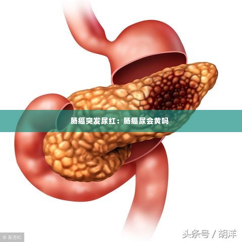 肠癌突发尿红:肠癌尿会黄吗