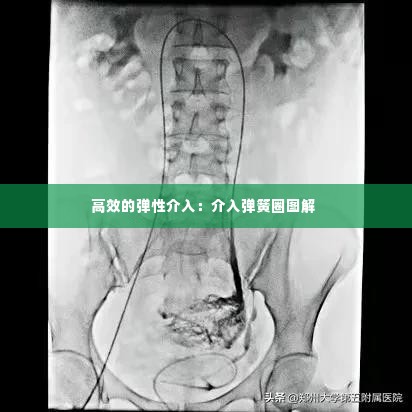 高效的弹性介入：介入弹簧圈图解 
