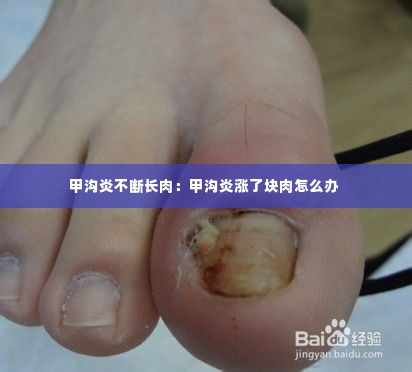甲沟炎不断长肉：甲沟炎涨了块肉怎么办 