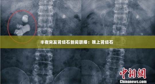 半夜突发肾结石新闻联播：晚上肾结石 