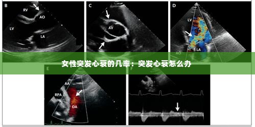 女性突发心衰的几率:突发心衰怎么办