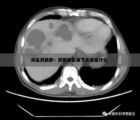 突发肝脓肿:肝脓肿发展下去会成什么