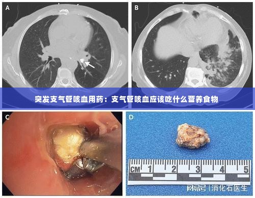 突发支气管咳血用药:支气管咳血应该吃什么营养食物