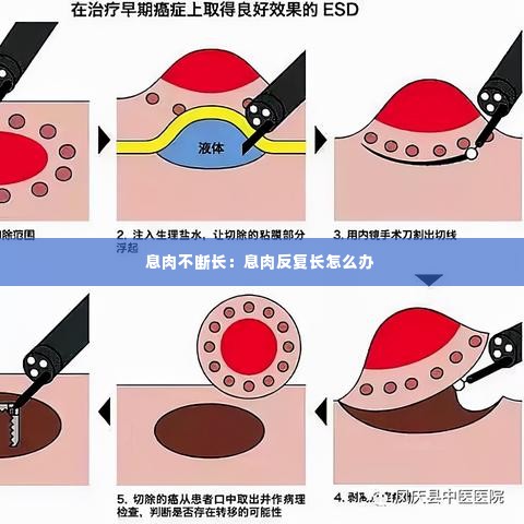息肉不断长:息肉反复长怎么办