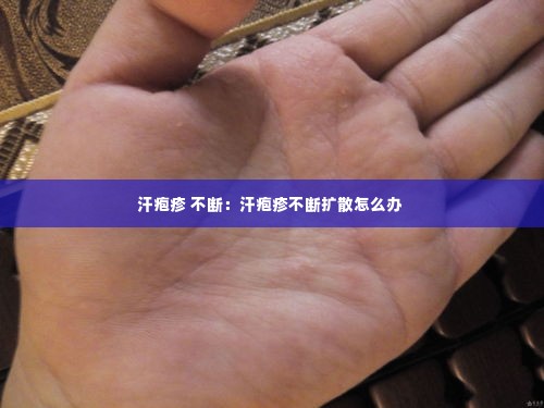 汗疱疹 不断:汗疱疹不断扩散怎么办