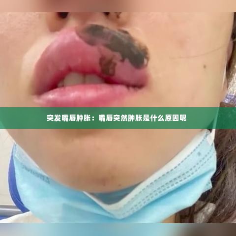 突发嘴唇肿胀:嘴唇突然肿胀是什么原因呢