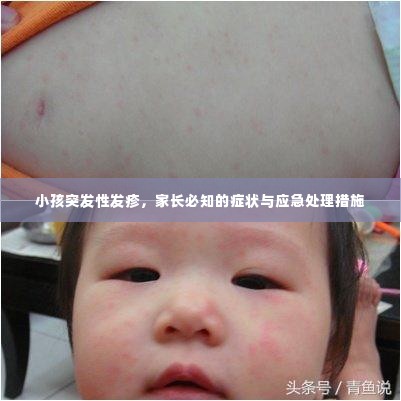 小孩突发性发疹,家长必知的症状与应急处理措施