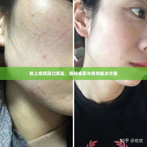 脸上痘痘闭口频发,揭秘成因与有效解决方案