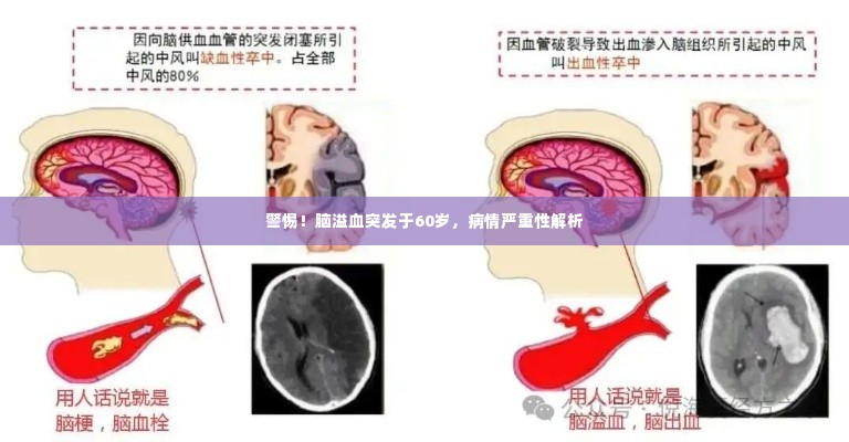 警惕！脑溢血突发于60岁，病情严重性解析