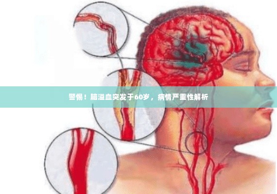 警惕!脑溢血突发于60岁,病情严重性解析
